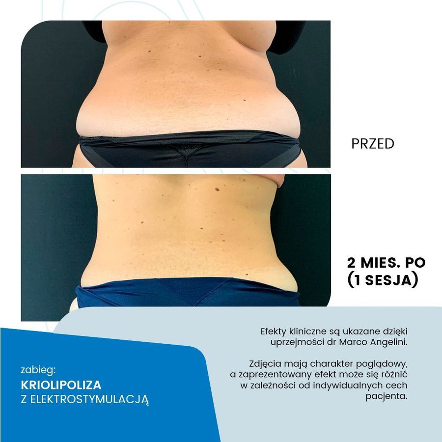 Przed i po kriolipolizie (talia) - materiał poglądowy producenta technologii