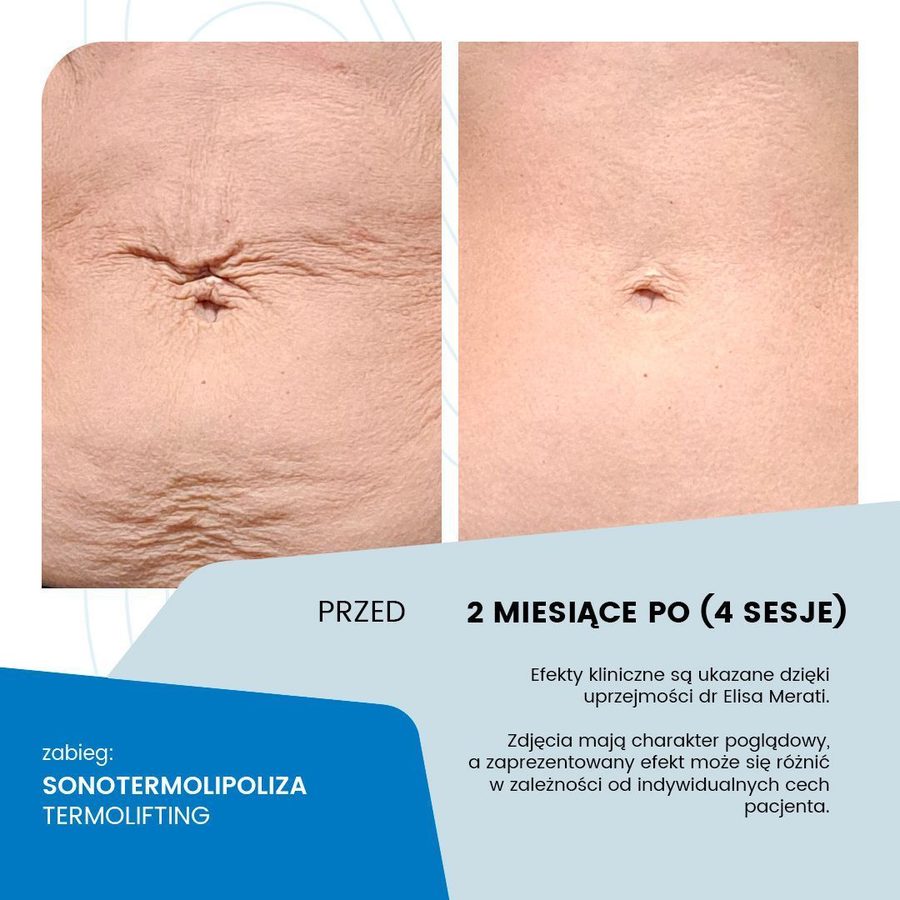 Przed i po zabiegu sonotermolipolizy - materiał poglądowy producenta technologii